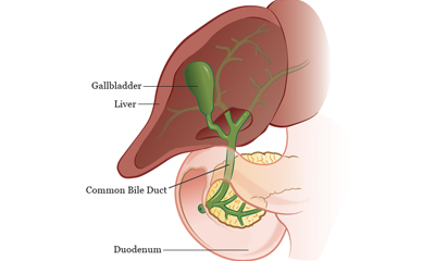 Liver Resections For Bile Duct Cancer