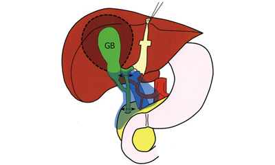 Radical Cholecystectomy For Gall Bladder Cancer