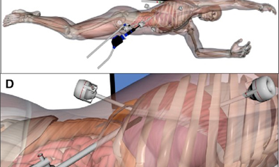 Laparoscopic Liver Resections