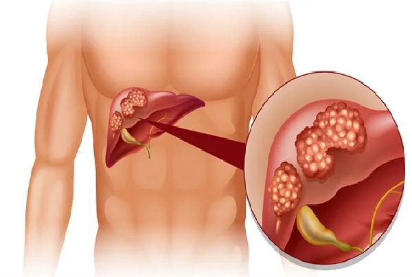 Liver Cancer