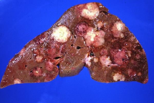 Non Cancerous tumors and infections of liver