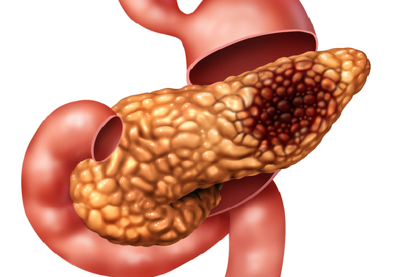 Cancer of Pancreas